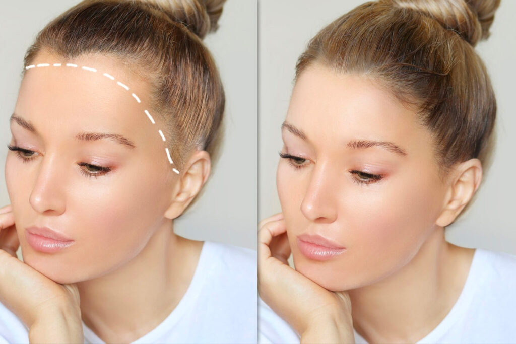 Haartransplantation Frauen Istanbul